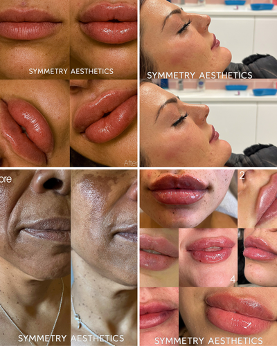 Dermal Filler