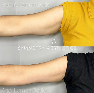 Fat Dissolving Injections